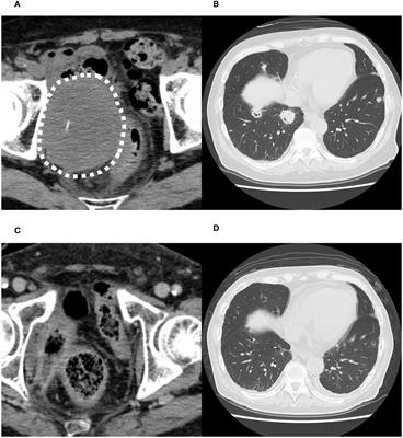 Metastatic bladder cancer forming a sigmoidorectal fistula after enfortumab vedotin therapy: a case report